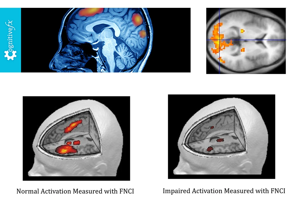 FNCI brain